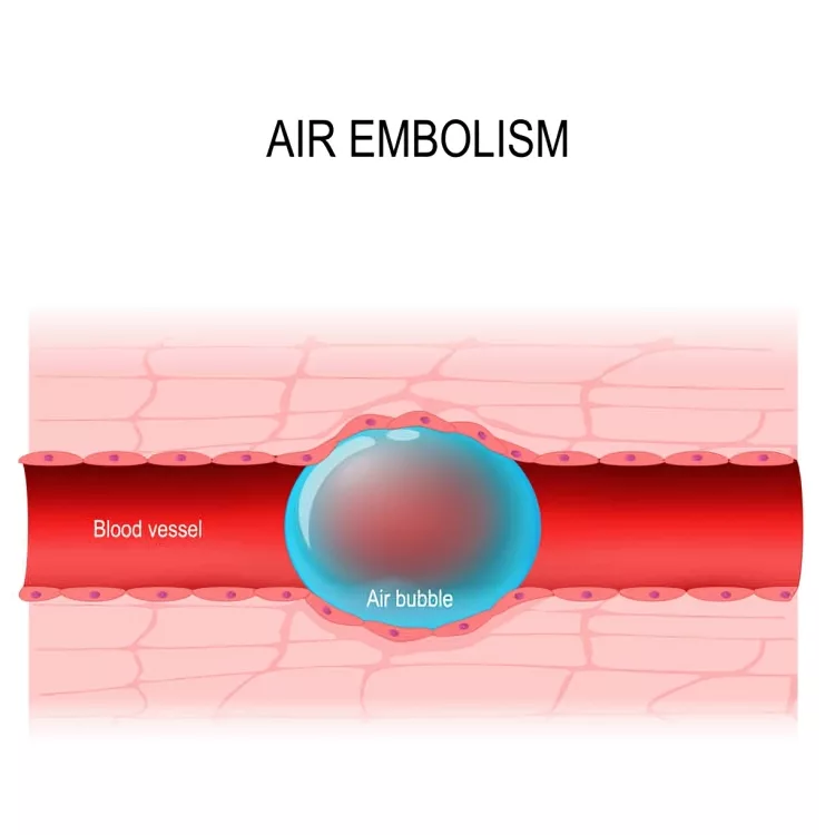 Air Embolism: Symptoms, Causes & Treatment Explained