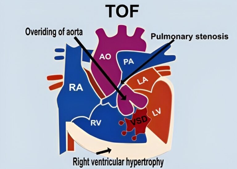 Tetralogy of Fallot (TOF): Understanding Cardiac Challenges