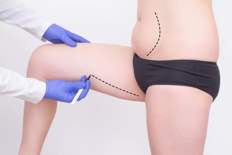 Thighplasty: What to Expect from the Procedure