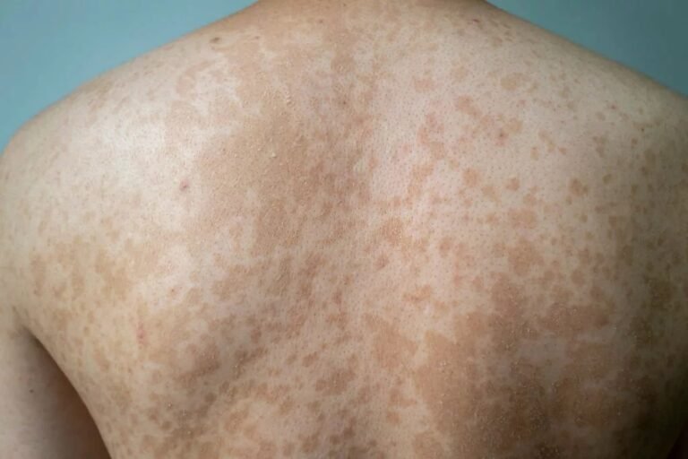 Tinea Versicolor: All the Information You Need