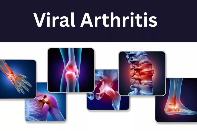 What is Viral Arthritis? Understanding Post-Viral Joint Pain
