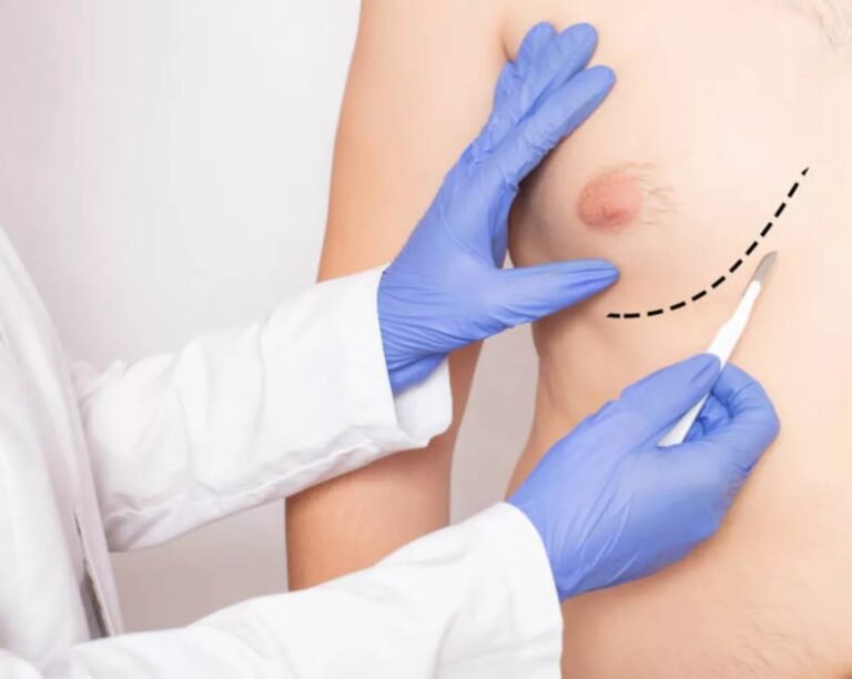 Gynecomastia Surgery: Procedure, Benefits, Risks & Recovery