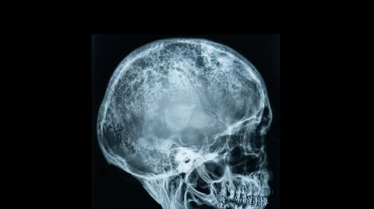 What is Paget’s Disease? Bone, Breast, and Extramammary Explained