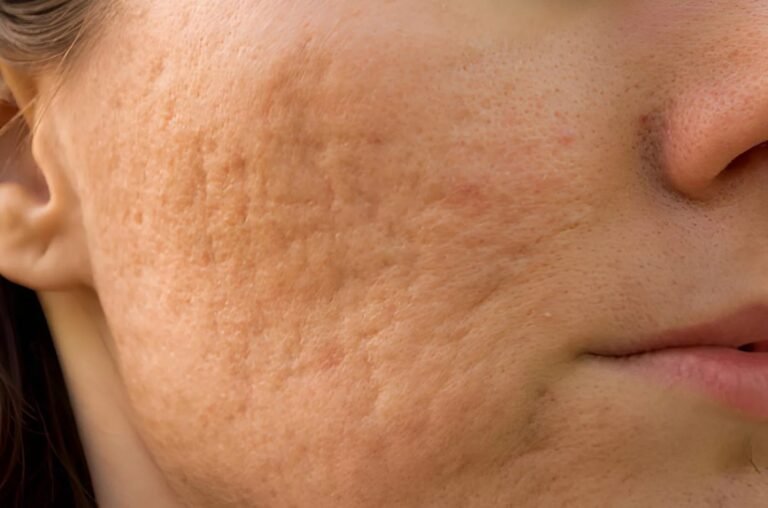 What Are Atrophic Scars? Causes, Types & Best Treatments