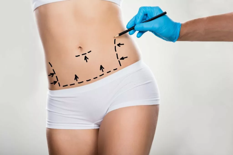 Mini Tummy Tuck: A Quick Guide to a Trimmed Waistline