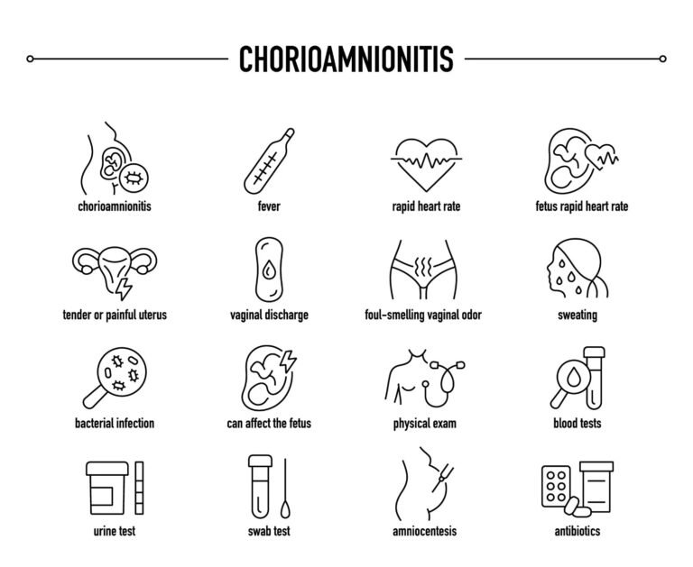 Chorioamnionitis: Causes, Symptoms, and Management