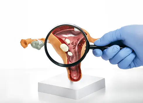 Uterine Polyps: Symptoms, Causes & Treatment Options