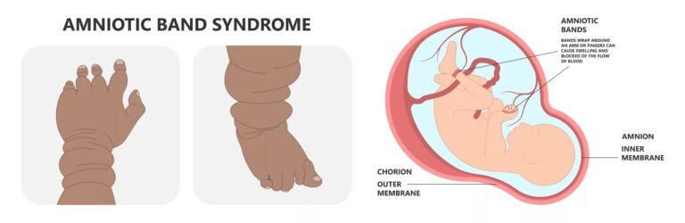 Amniotic Band Syndrome: Causes, Signs, and Care