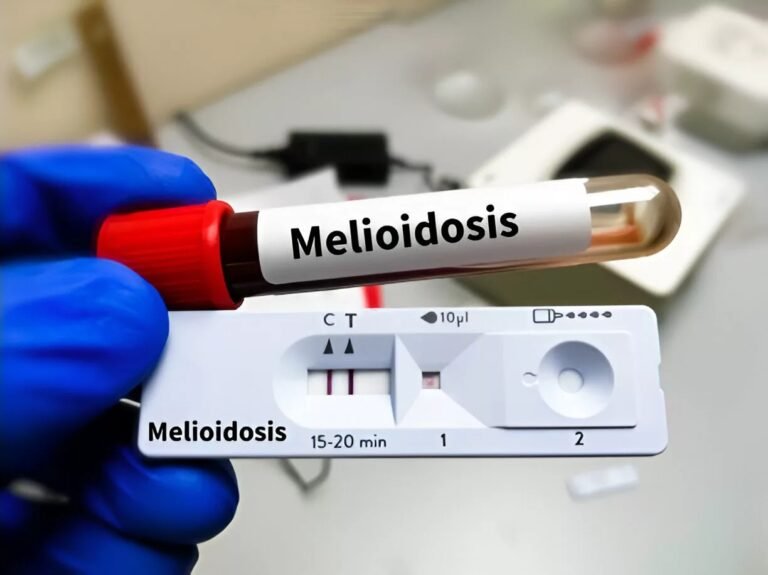 Melioidosis: How It Spreads & Ways to Stay Safe