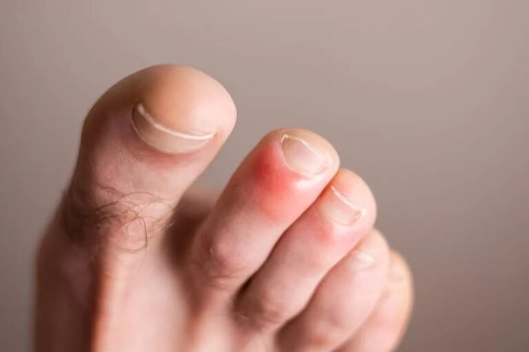 CHILBLAINS: Causes, Symptoms, and Prevention