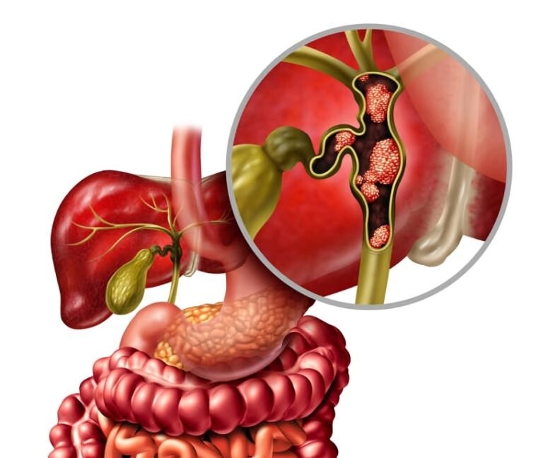 Cholangiocarcinoma: Symptoms, Risks & Treatment Explained