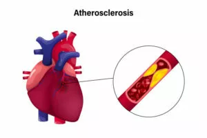 Aortic Atherosclerosis: Complete Guide with Prevention Tips