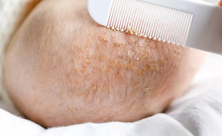 Cradle Cap: Causes, Symptoms & Care for Your Baby’s Scalp