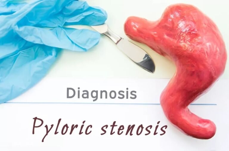 Pyloric Stenosis: Causes, Symptoms & Treatment Explained