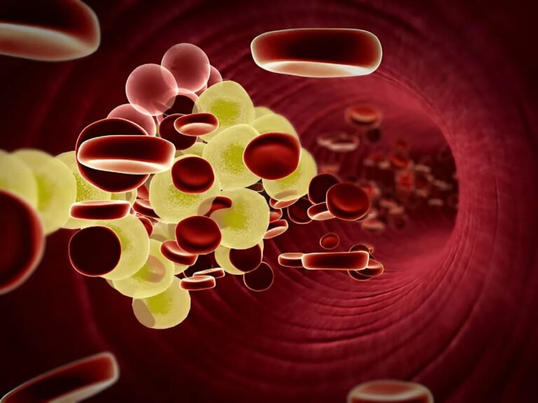 Fat Embolism Syndrome: Causes, Symptoms & Treatment