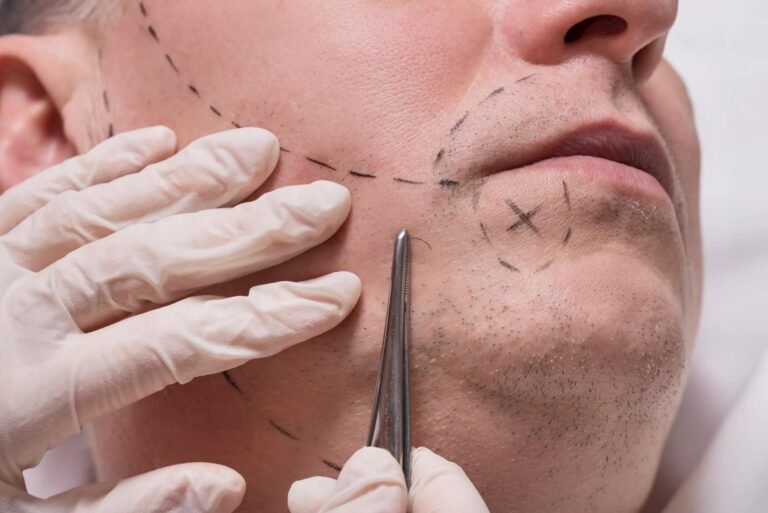Beard Transplant: All You Need to Know