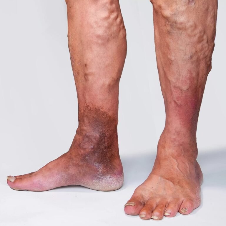 Reticular Veins: Causes, Symptoms & Effective Treatment Options
