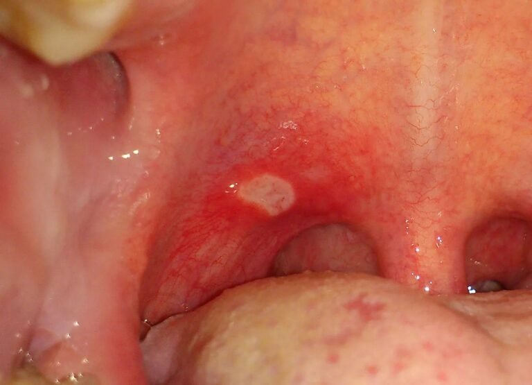Aphthous Stomatitis: Triggers and Treatment for Recurrent Mouth Ulcers