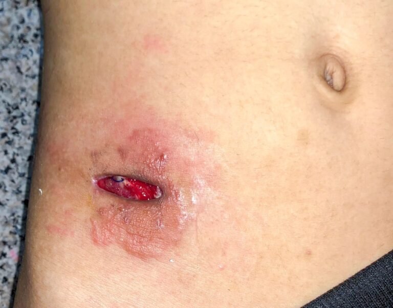 Wound Dehiscence: Causes, Symptoms, and Treatment Explained
