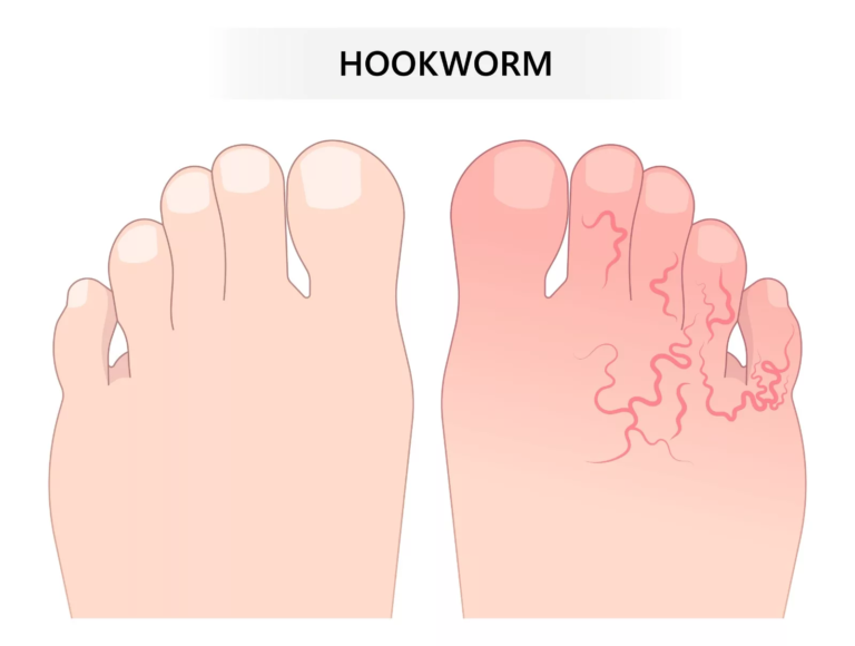 Hookworm Infection: Causes, Symptoms & Prevention