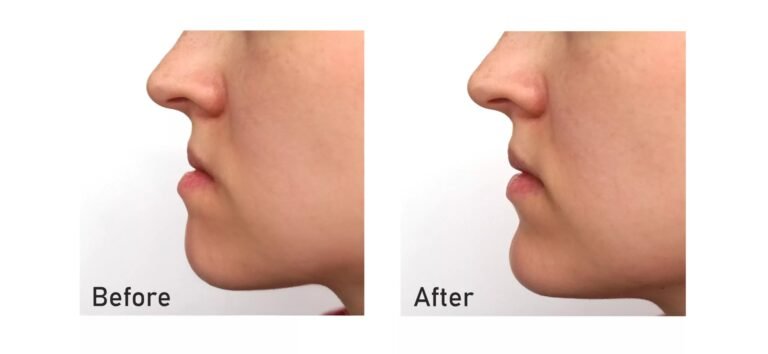 Orthognathic Surgery: Improving Jaw Alignment & Health
