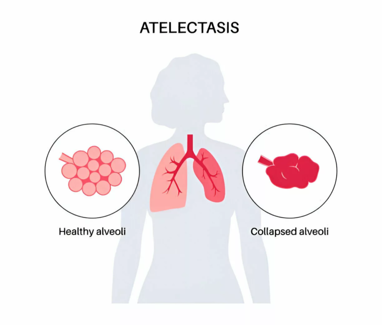 Atelectasis: Diagnosis, Causes, Symptoms & Treatments