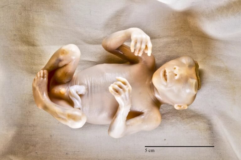 Anencephaly: Exploring a Rare Neural Tube Defect