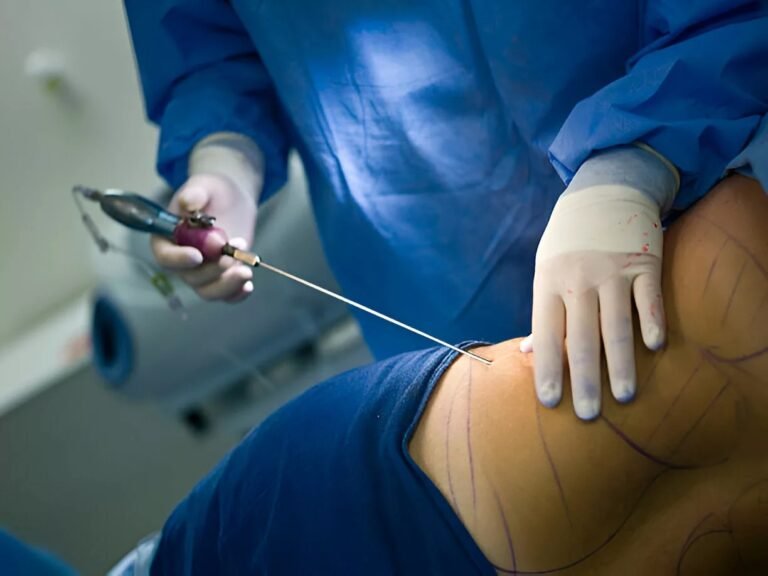Lipoplasty: Exploring Procedures & Techniques