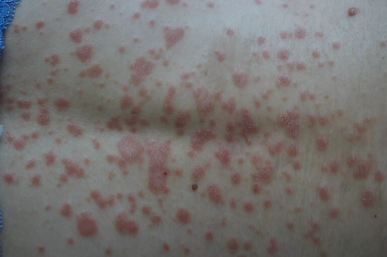 Guttate Psoriasis: Diagnosis, Symptoms and Treatment