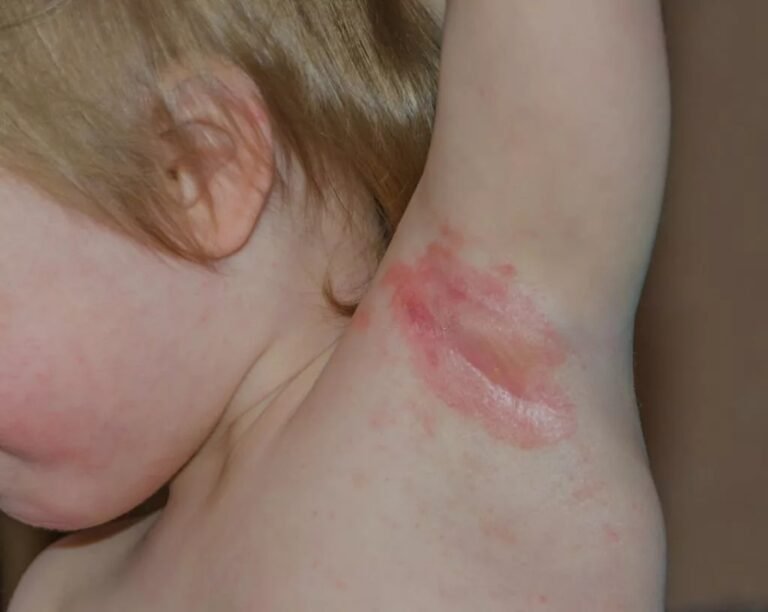 Cutaneous Candidiasis: Causes, Symptoms & Treatment Options