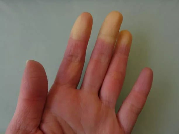 Scleroderma: Understanding the Symptoms, Causes & Treatments