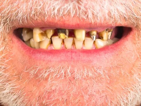 Scurvy: Causes, Symptoms & Treatment