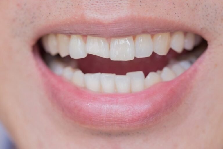 Chipped Tooth – What to do?