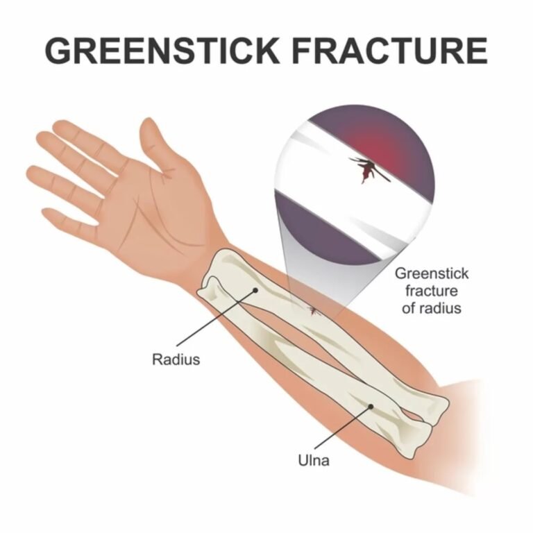 Greenstick Fracture: A Common Incomplete Bone Injury in Children