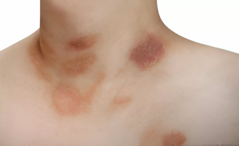 Pityriasis Rosea: Symptoms, Causes & Effective Treatments