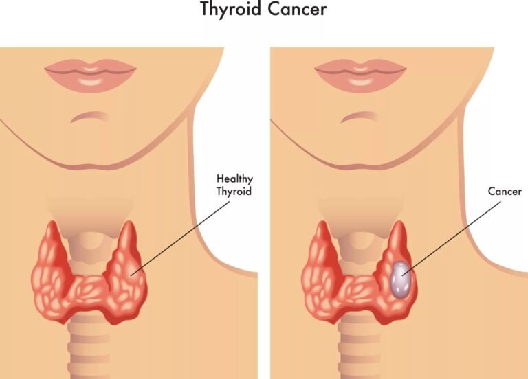 Medullary Thyroid Carcinoma: Signs and Diagnosis