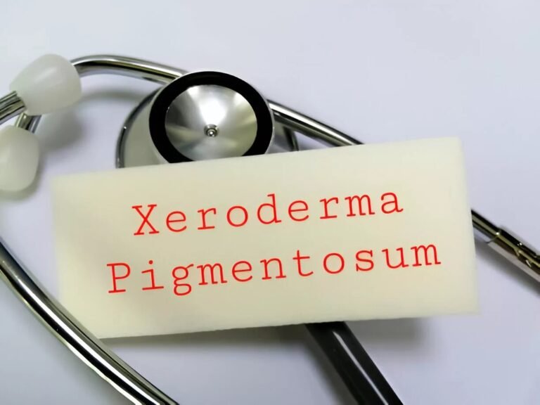 Xeroderma Pigmentosum: Symptoms, Causes and Treatment