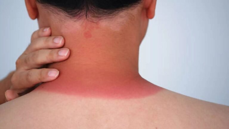 Dermatomyositis: Symptoms, Causes, and Treatment Guide