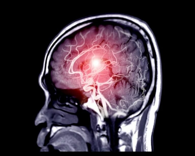 Carotid Artery Stenosis: Symptoms, Diagnosis & Treatment