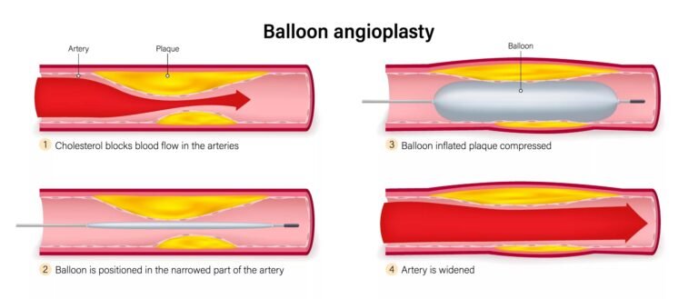 Balloon Angioplasty: Restoring Blood Flow Safely & Effectively