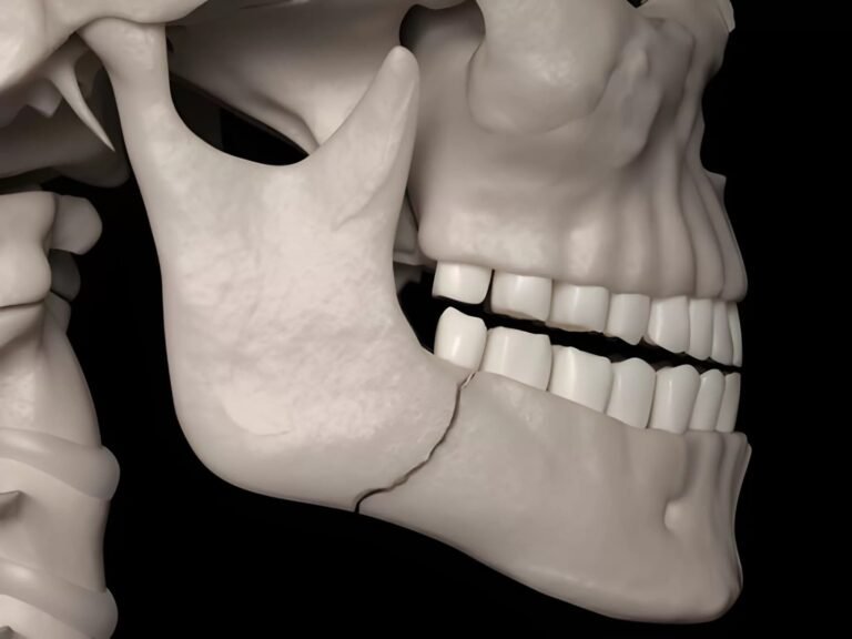 Jaw Fractures: What Happens When the Jaw Breaks