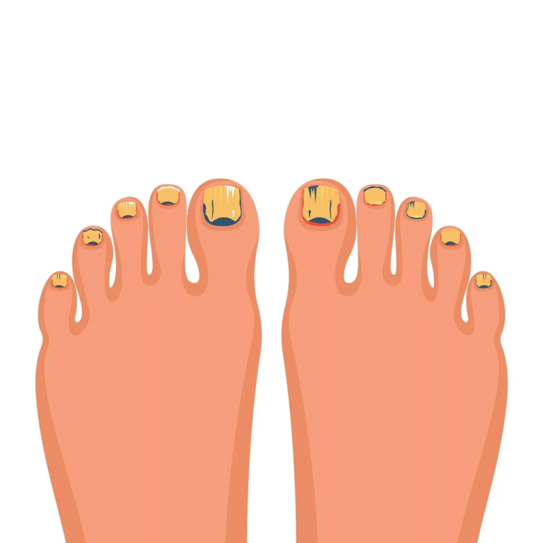 Onychomycosis: Causes, Symptoms, and Treatment