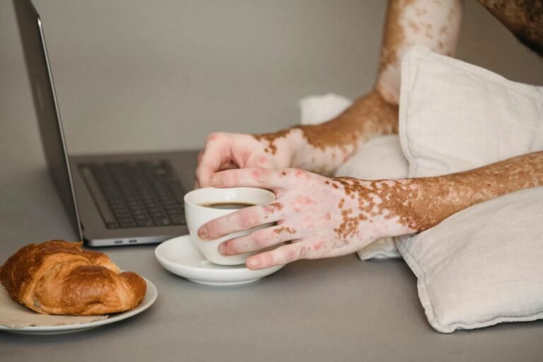 What Causes Vitiligo? A Complete Guide to White Patches on Skin